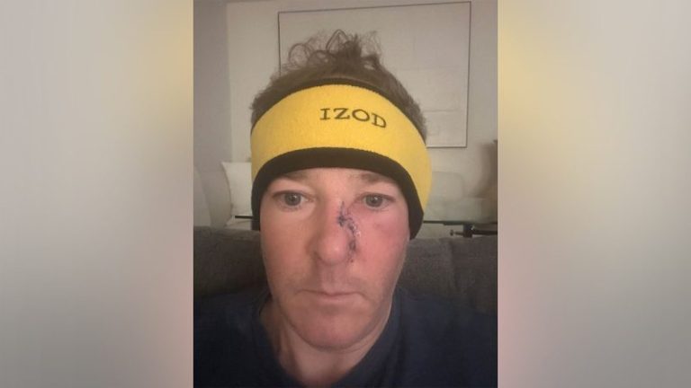 EPA administrator Lee Zeldin reveals he underwent surgery to remove skin cancer from his face